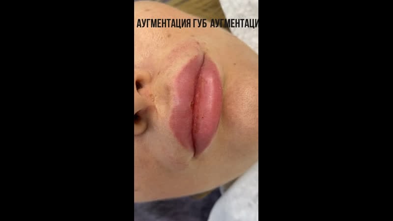 Аугментация губ
