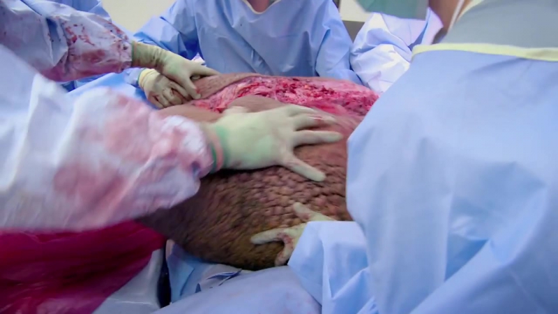 Une opération de plus de 8 heures les plus gros testicules au monde