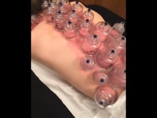 Chinese cupping therapy