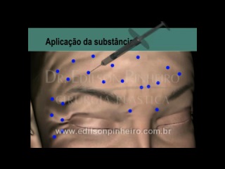 Botox cirurgia plástica em 3d antes e depois