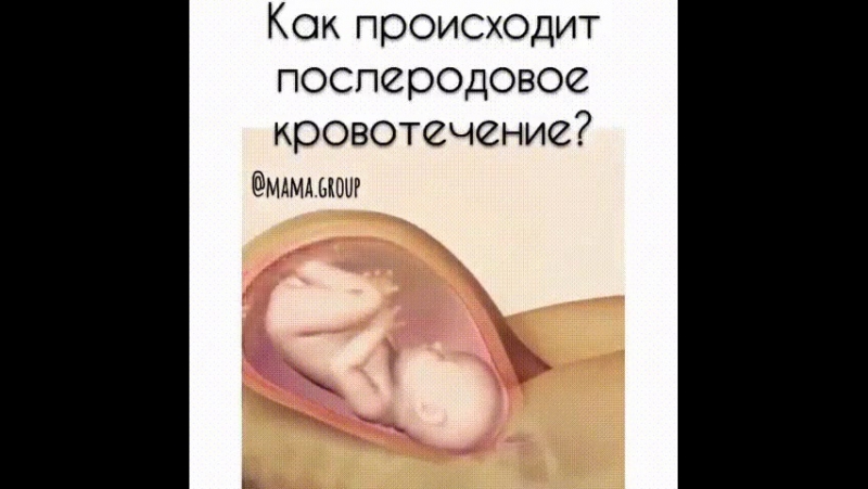 Послеродовое кровотечение