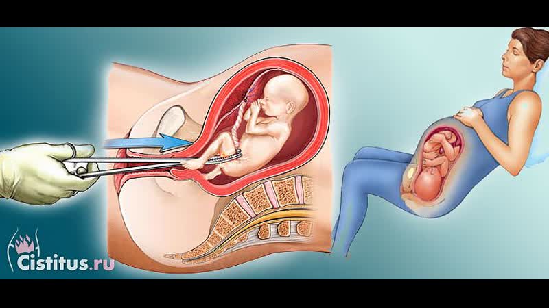 Аборты, карма, молодые, сущность, секс, замершая беременность, уродливый плод,
