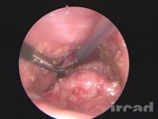 Imperforate anus pull through procedure laparoscopic surgery on the e surgical reference vd01en1883