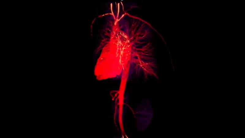 Магнитно резонансная 3d визуализация сосудов