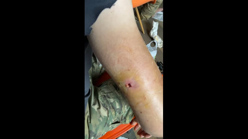 Огнестрельное ранение правого плеча 7,62х54 лпс (пк)