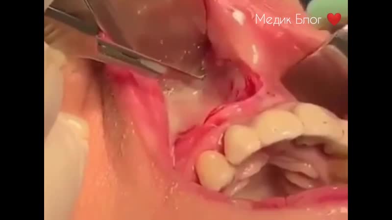 Вскрытие абсцесса 🔪