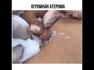 Удаление жировика