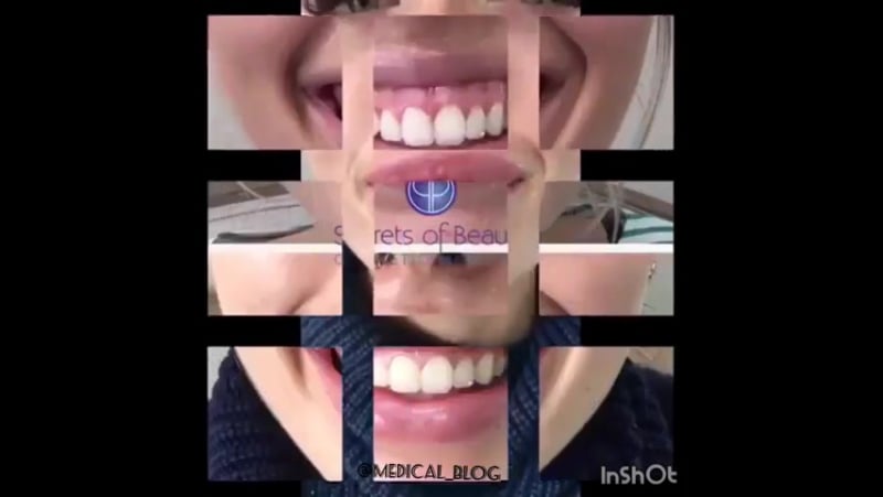 Инъекции ботокса устранение гингивальной (десновой) улыбки