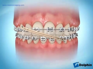 Elastics (midline correction) wmv orthodontic elastics ортодонтия
