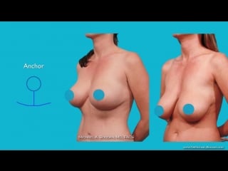 Breast lift surgery doughnut, lollipop, anchor mastopexy