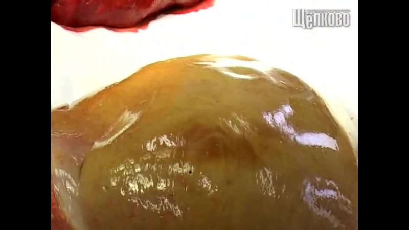 Печень и сердце алкоголика