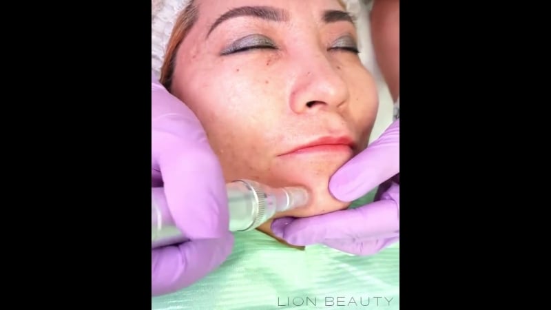 Выравнивание кожного рельефа с помощью препарата "лаеннек"