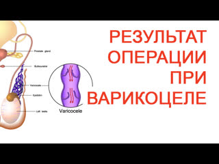 Результат операции при варикоцеле