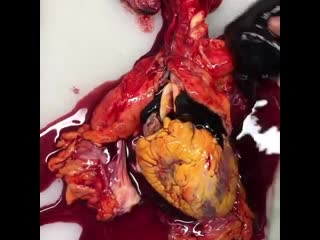 Массивная гемоперикард после разрыва сердечной мышцы или из за острого инфаркта миокарда!