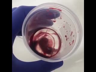 Плод 9 недель аборт после внематочной беременности