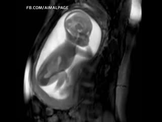 Clearest mri footage of a pregnancy