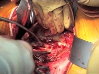 Open retroperitoneal approach for an aortoiliac aneurysm using a bifurcated aort