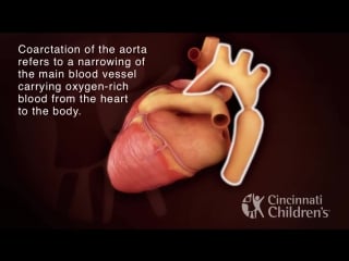 Coarctation of the aorta
