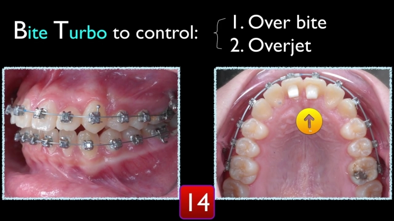 Simplify cii correction part 4 ортодонтия