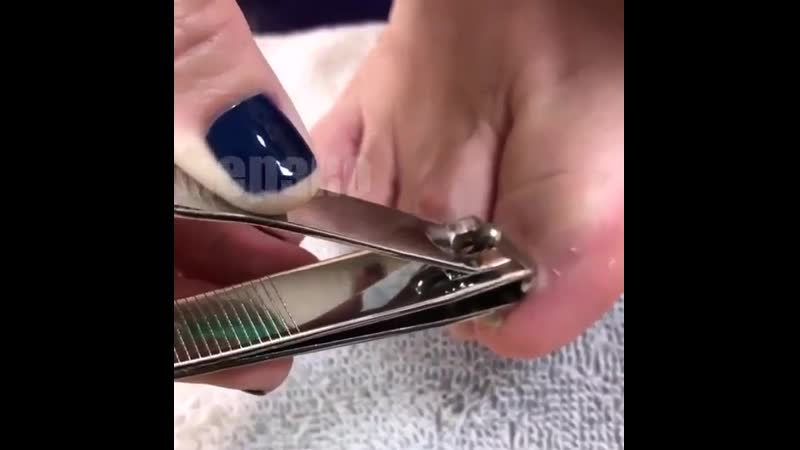 😫 удаление вросшего ногтя