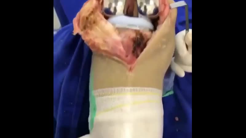 Эндопротезирование коленного сустава