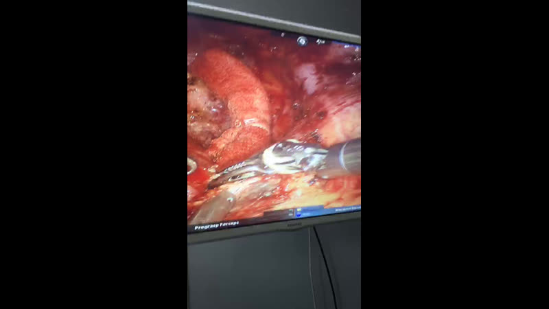 Выделение верхней вены