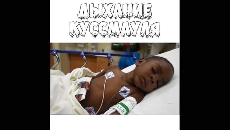 У пациента на видео сахарный диабет, который осложнился кетоацидозом, в следствии чего появилось дыхание куссмауля