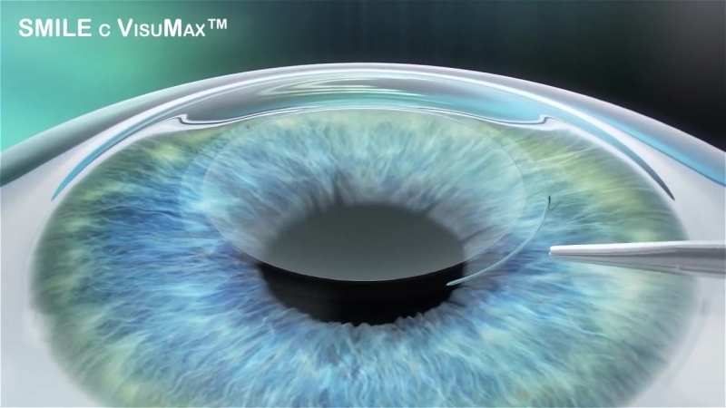Фемтосекундный лазер visumax