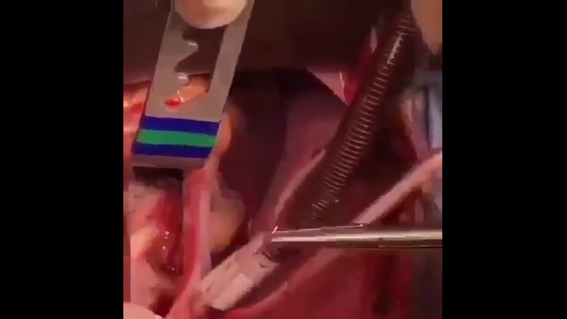 Оперирование митрального клапана