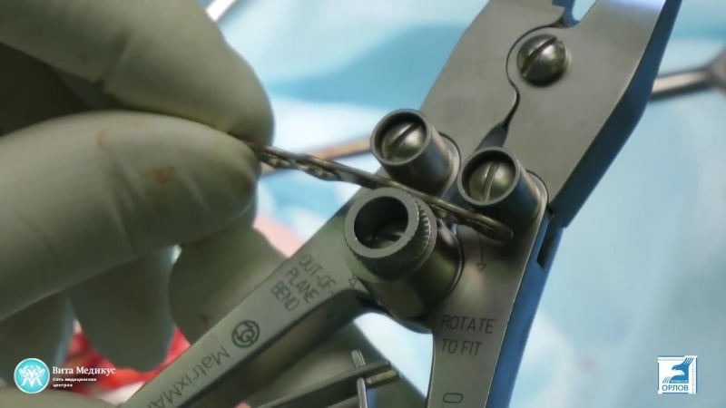 Репозиция фрагментов тела нижней челюсти после ранения