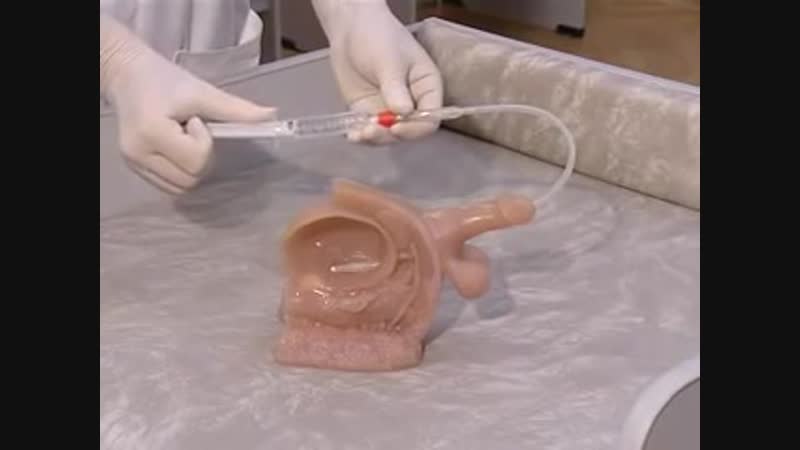 Катетеризация мочевого пузыря катетером фолея