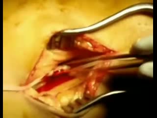 Удаление тромбов и эмболов с помощью баллонного катетера типа фогарти