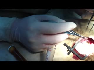 Операция по вытаскиванию червя из глаза