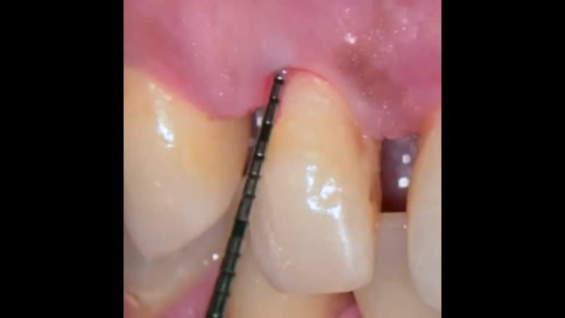 Базовая пародонтология зондирование