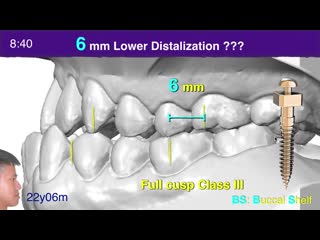 Chris chang screws for fixed appliances and aligners 2020 aao part i