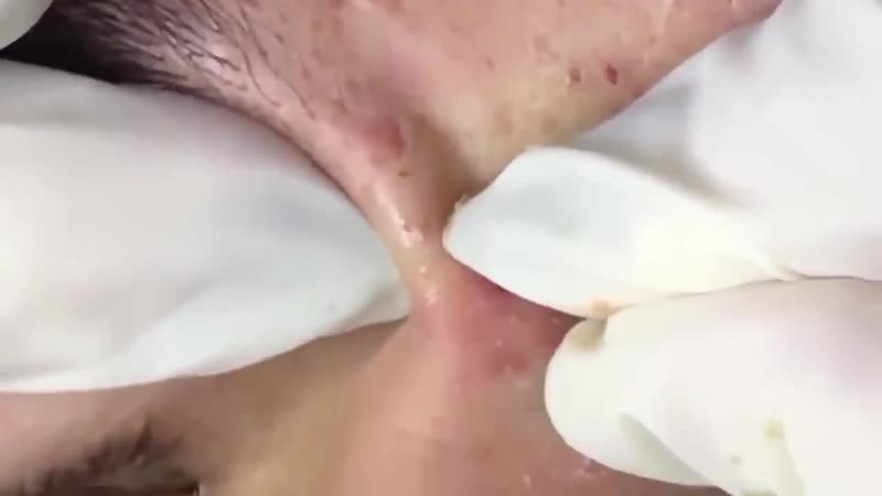 Удаление акне (20 минут)