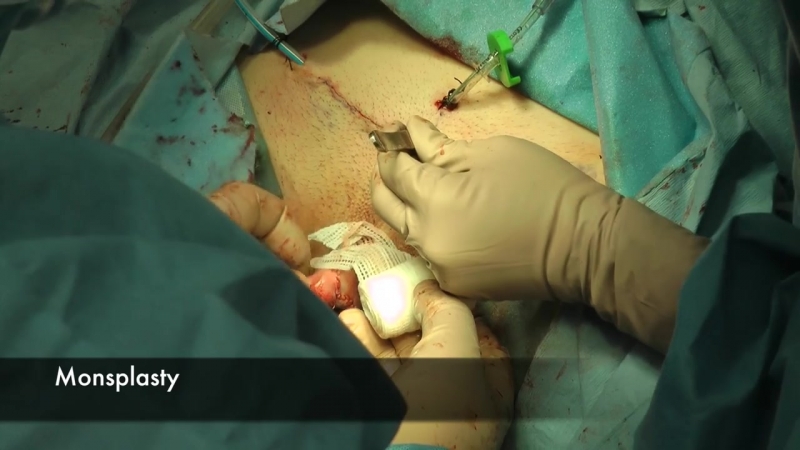 Метоидиопластика – передовые методы трансгендерной хирургии