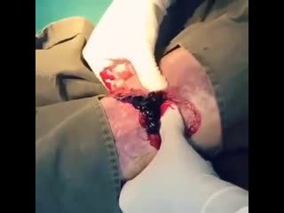 Удаление гематомы из ноги после травмы