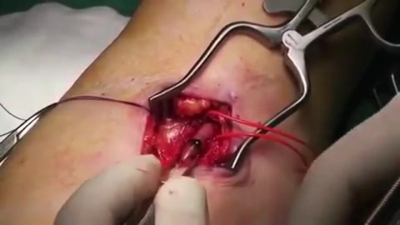 Отличная съемка плечевой эмбоэктомии!