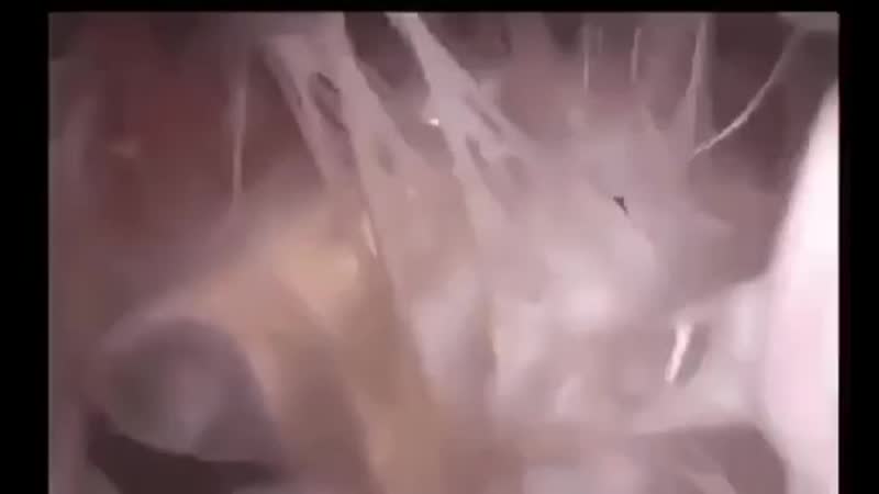 Аортальный и митральный клапаны сердца