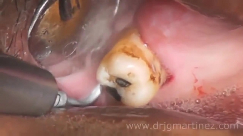 Абсцесс зуба