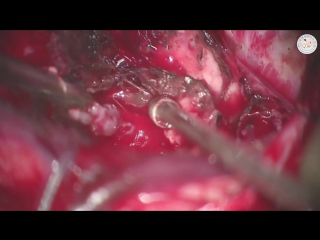 Anteromedial temporal lobectomy and amygdalohippocampectomy