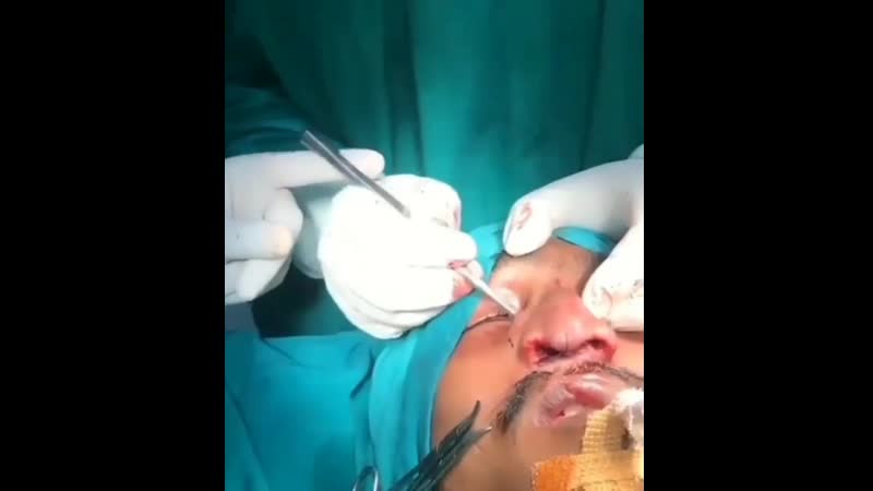 На видео выполняется процедура «остеотомия»