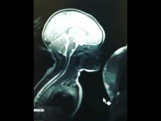 Мрт ребенку во время кормления грудью!