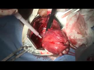 Total abdominal hysterectomy with enseal x1 large jaw mp4