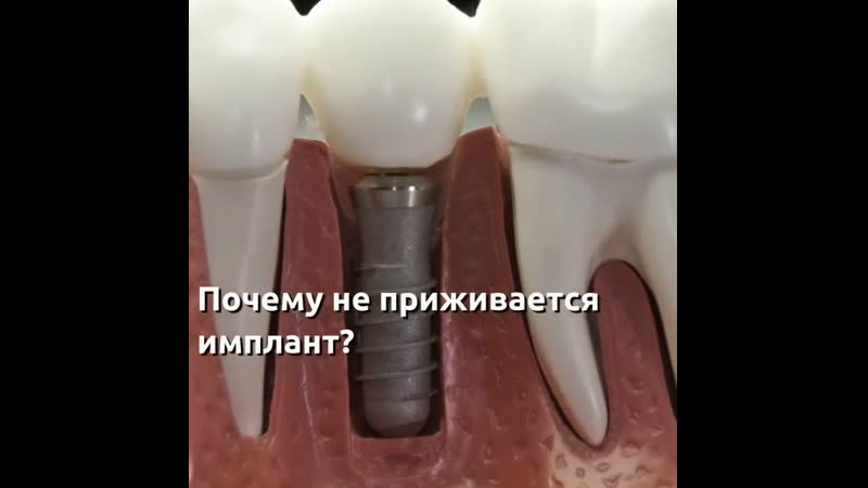 Имплант porn video – Почему не приживается имплант?