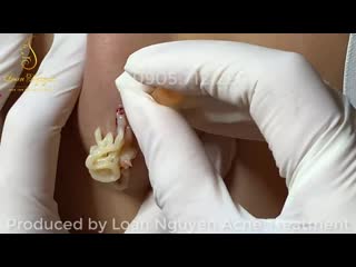 Киста на боку размером с ладонь