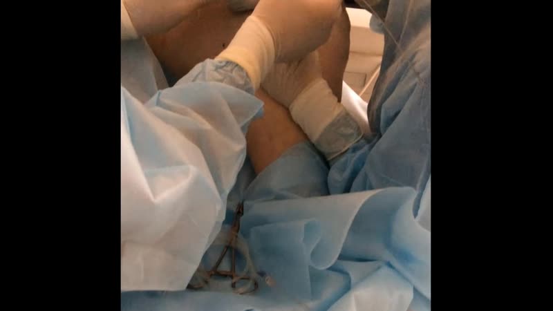 Лечение варикоза лазером