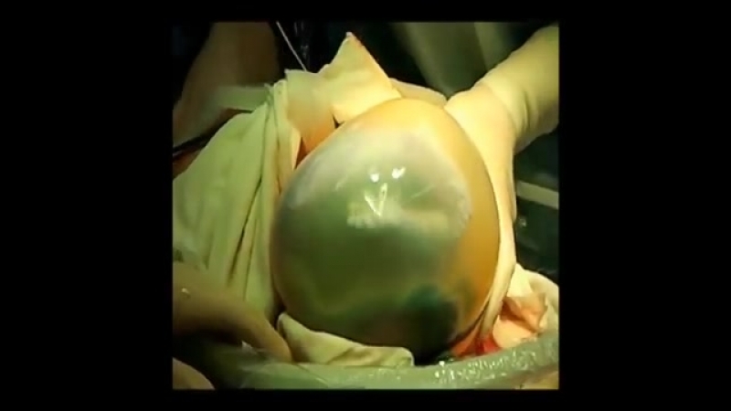 Извлечение плода в целом плодово плацентарном комплексе