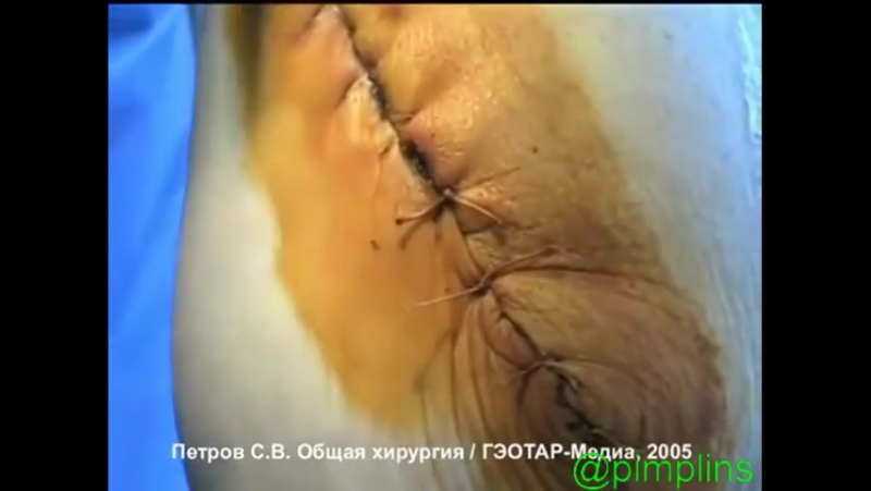 Снятие швов с послеоперационной раны